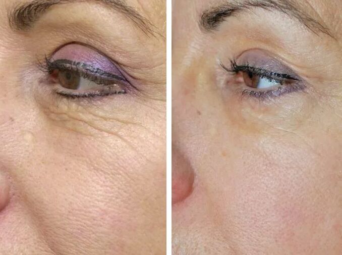 Laser de terrain avant et après