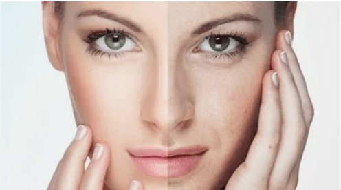 Rajeunissement efficace du visage